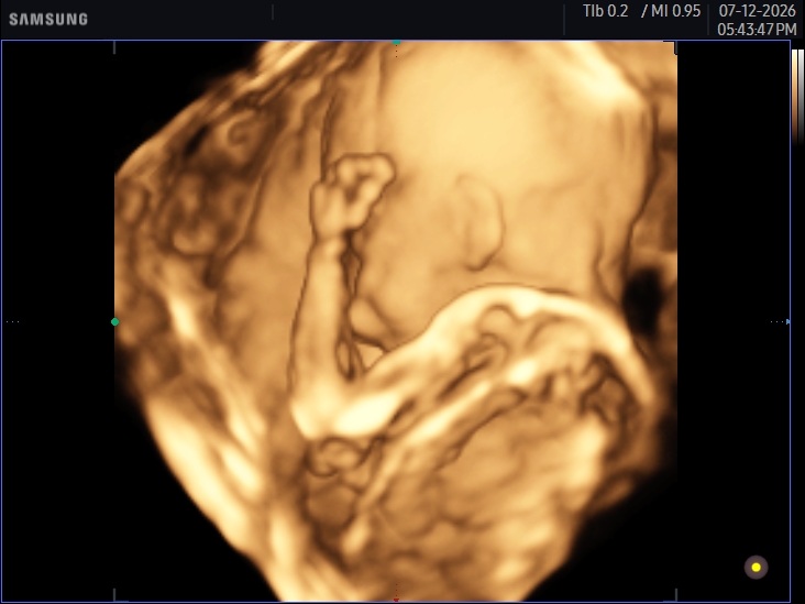 3D ultrasound image