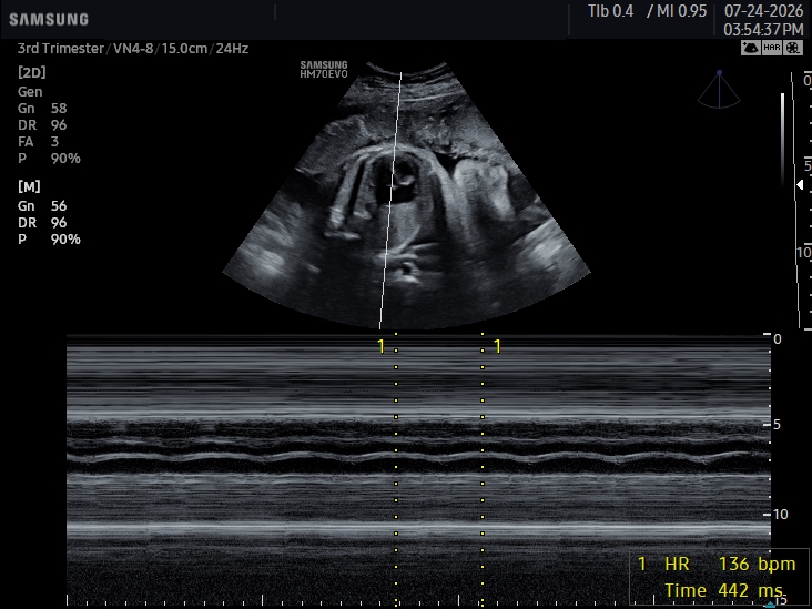 2D Heartbeat Check ultrasound scan