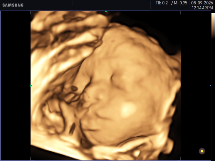 3D ultrasound image