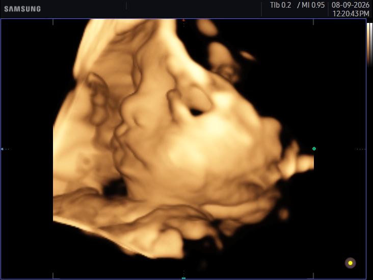3D ultrasound image