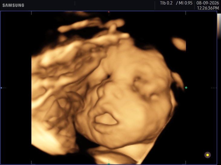 3D ultrasound image
