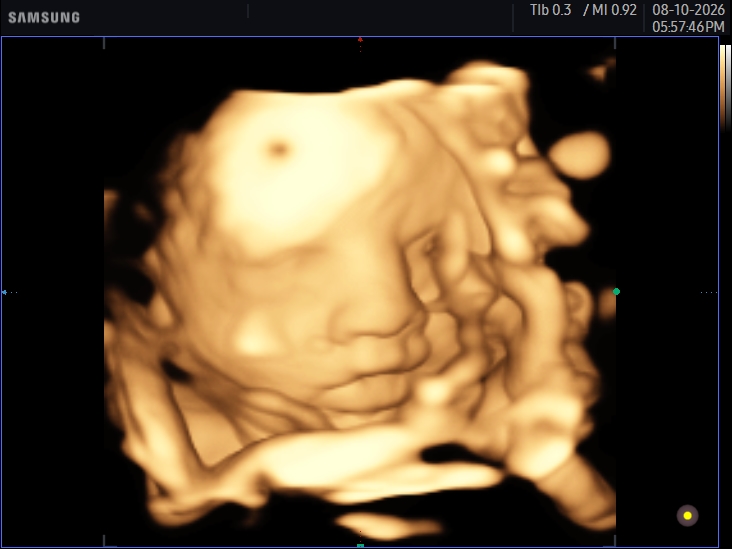 3D ultrasound image