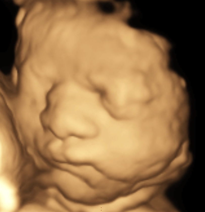 3D ultrasound image